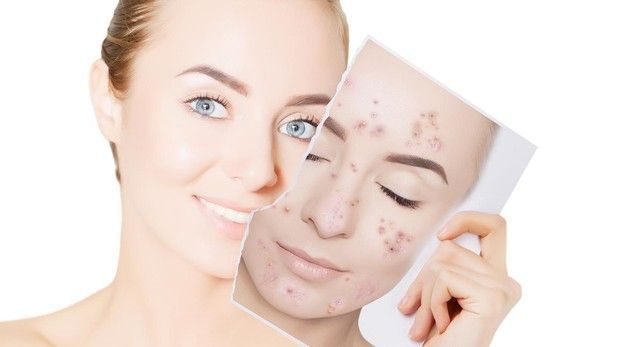 ¿Como prevenir y acabar con el odioso Acné?